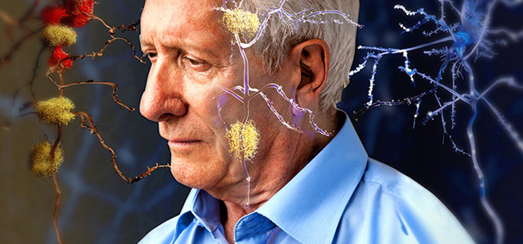 Alzheimer: la scoperta dell’origine del morbo