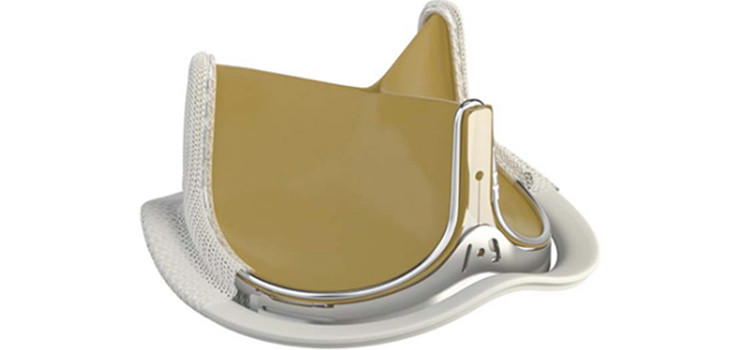 Sanità: impiantata per la prima volta in Puglia una bioprotesi valvolare aortica Sanità: impiantata per la prima volta in Puglia una bioprotesi valvolare aortica